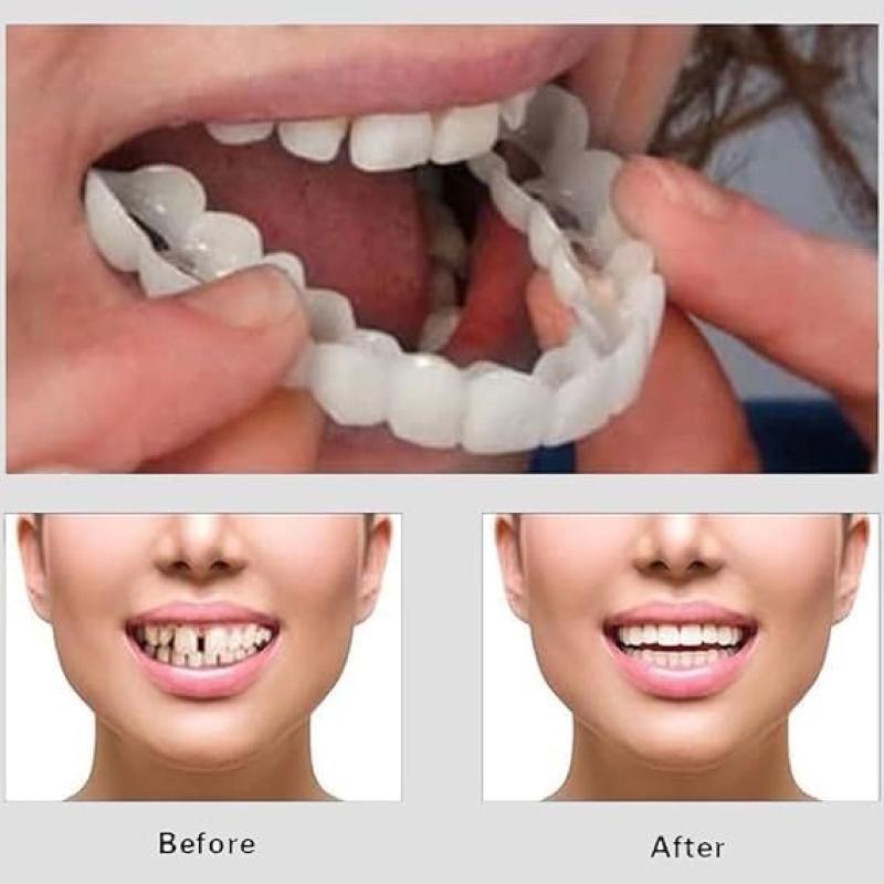 Snap On Smile Veneers – Instant Fake Teeth Kit for Men & Women | Moldable Cosmetic Teeth